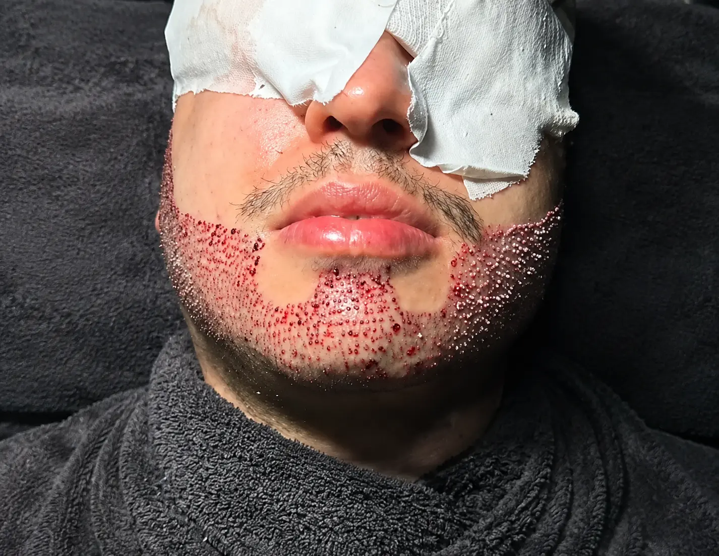 Careful follicular implantation during a beard transplant procedure