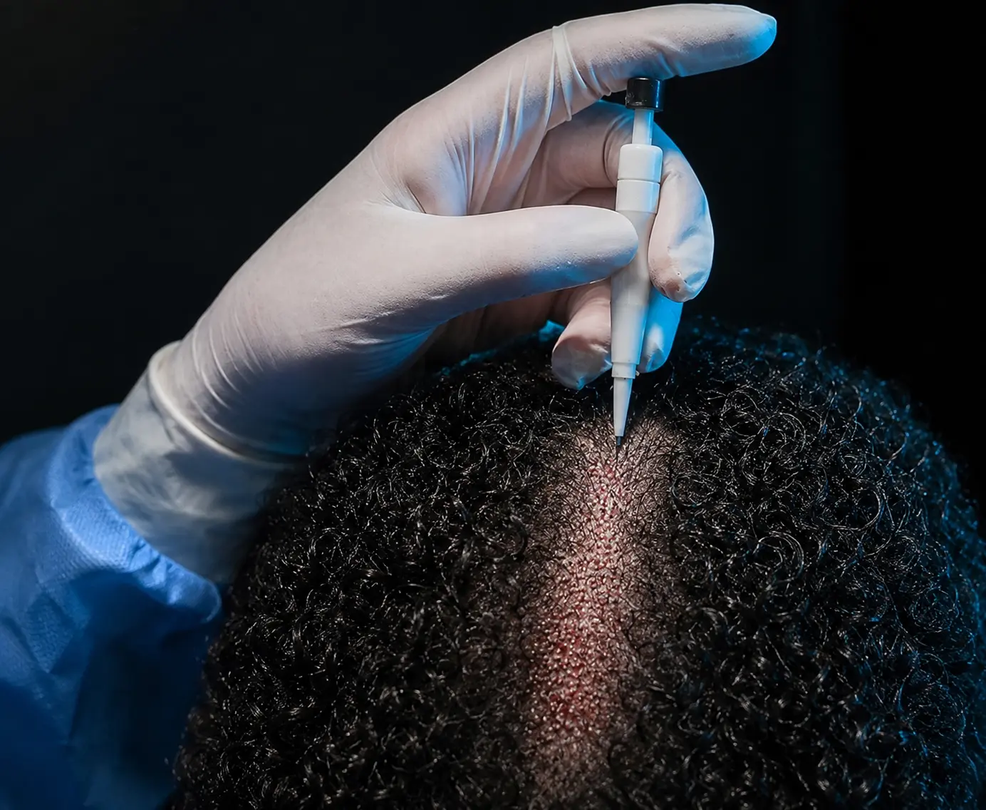 DHI hair transplant implantation with a precision implanter pen
