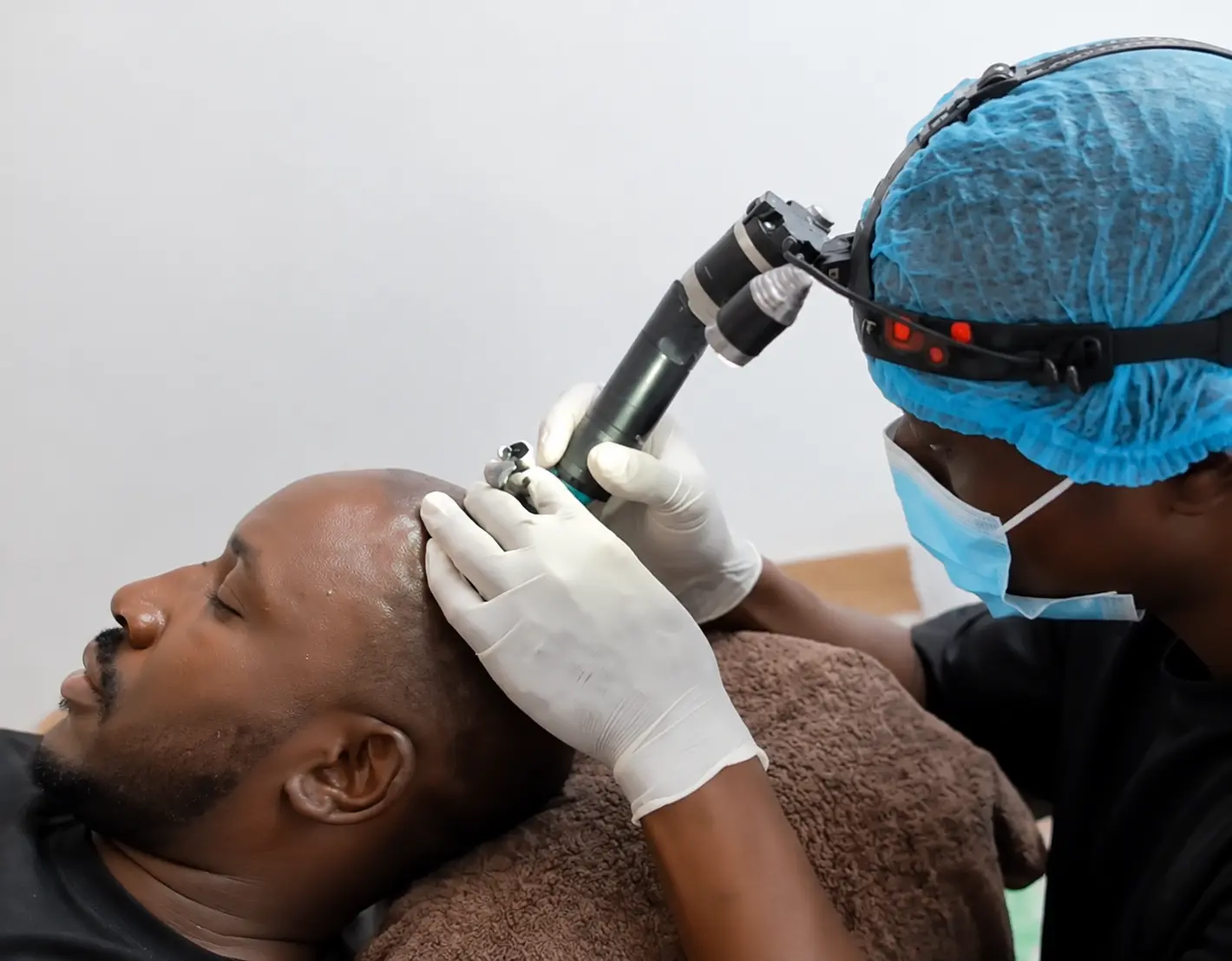 Live scalp micropigmentation procedure performed with magnification