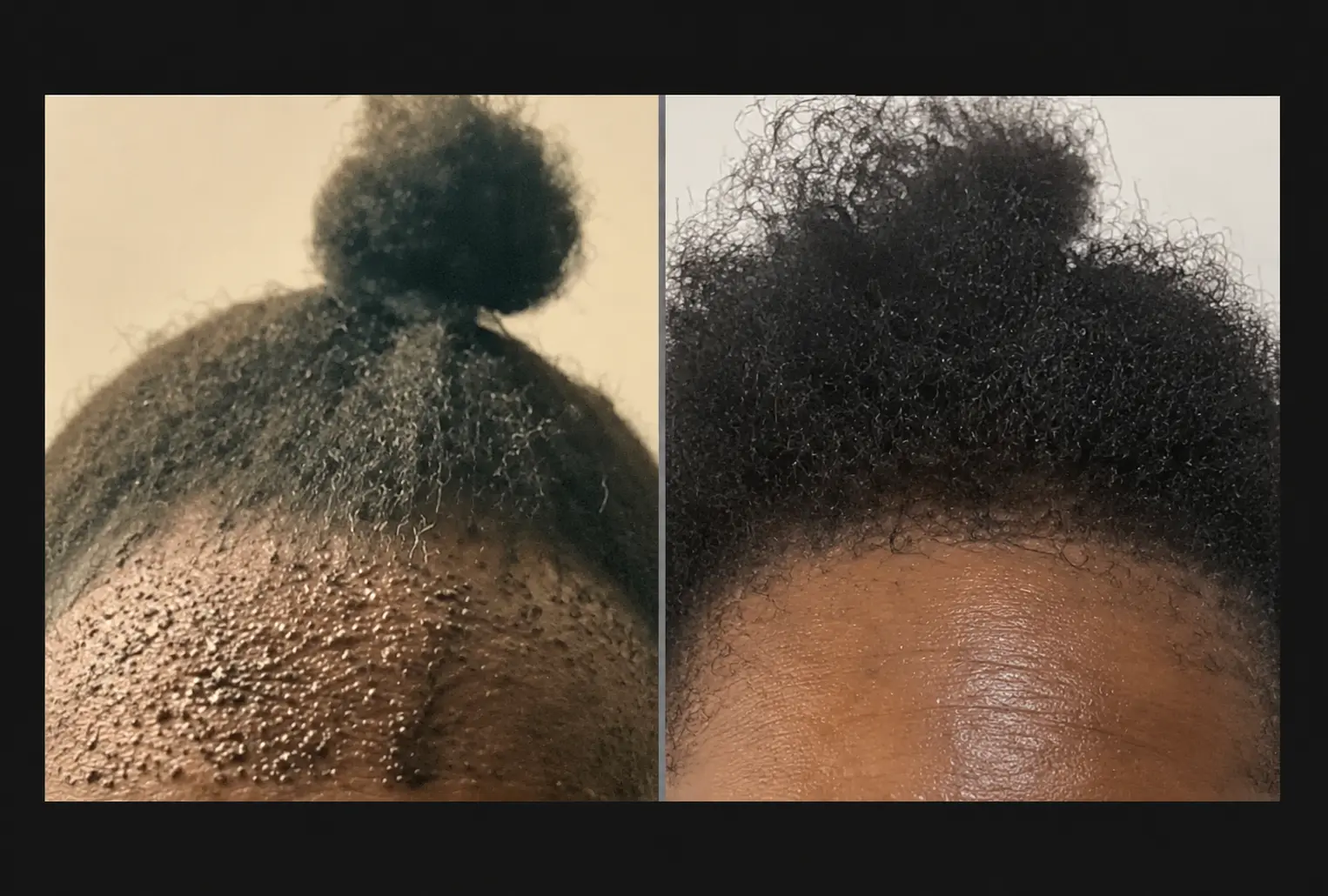 Real female client hair restoration progress from the first day to a later growth stage