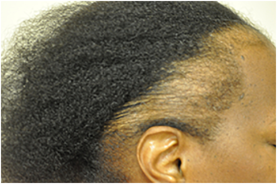 Exploring Solutions for Women Dealing with Hair Loss