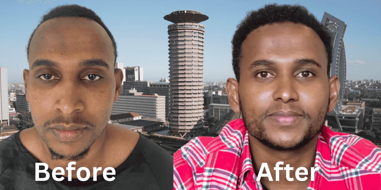 Sheriff’s Hair Transplant in Nairobi Journey
